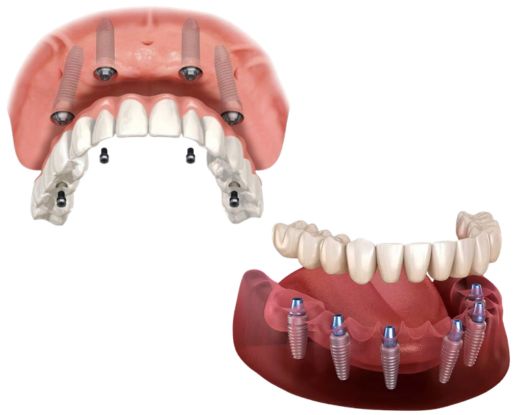 Ilustração 3D de protocolo de implante dentário superior e inferior